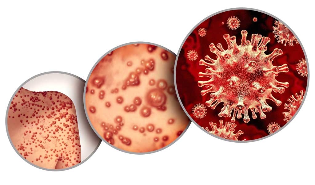 Trung Quốc  phát triển bộ kit test phát hiện virus bệnh đậu mùa khỉ Trung Quốc  phát triển bộ kit test phát hiện virus bệnh đậu mùa khỉ